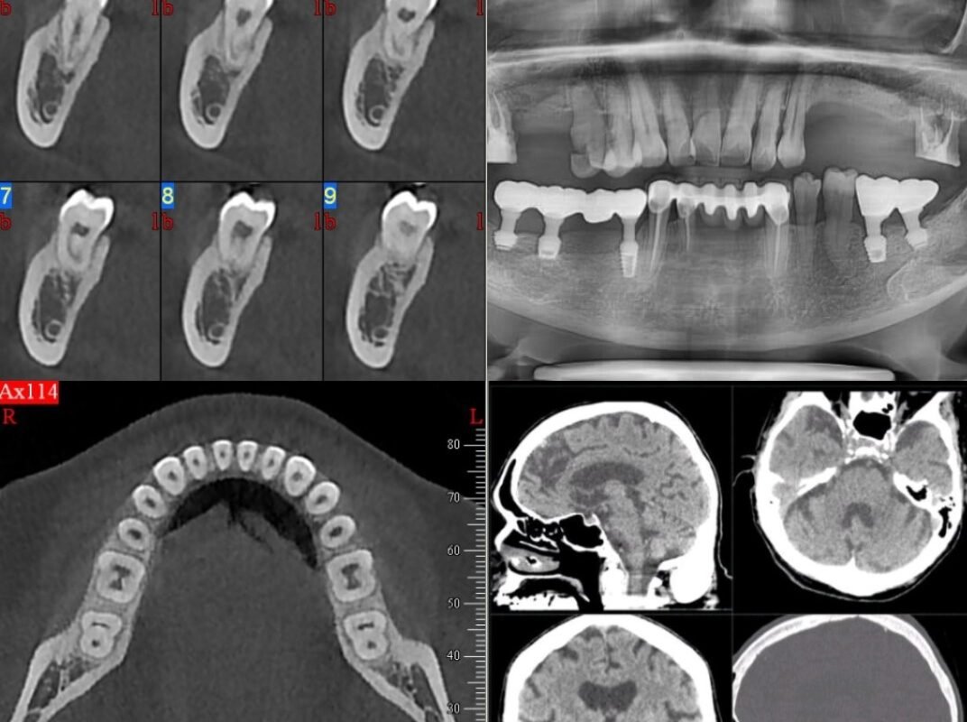 Dental CBCT imaging of the Teeth and skull.